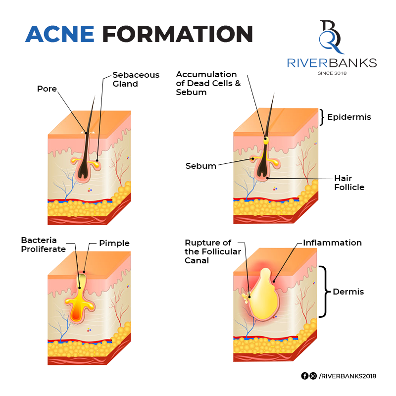 ఉత్తమ ఫలితాల కోసం ANTI ACNE COMBO