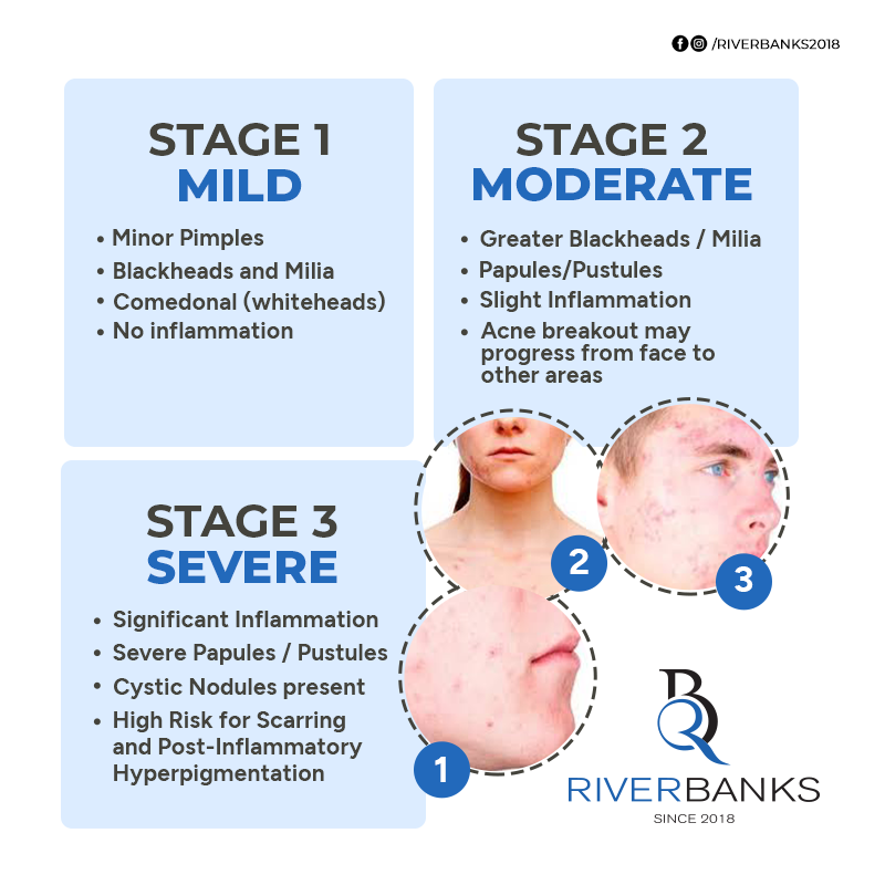 ఉత్తమ ఫలితాల కోసం ANTI ACNE COMBO