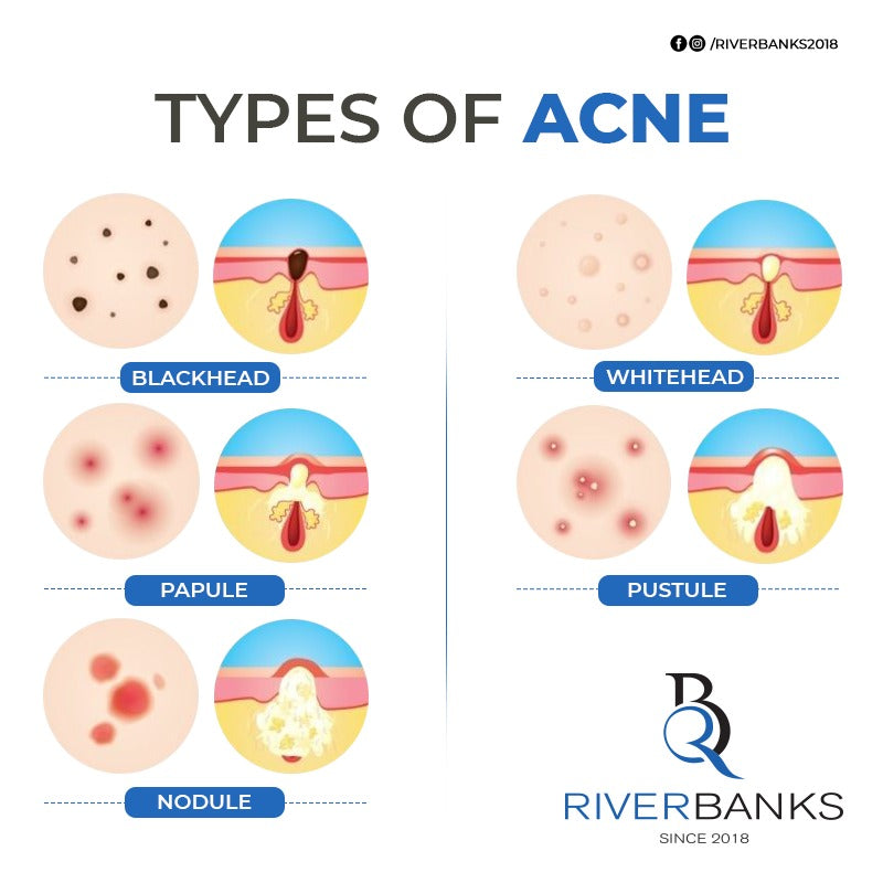 ANTI ACNE 2% సాలిసిలిక్ యాసిడ్ సీరం