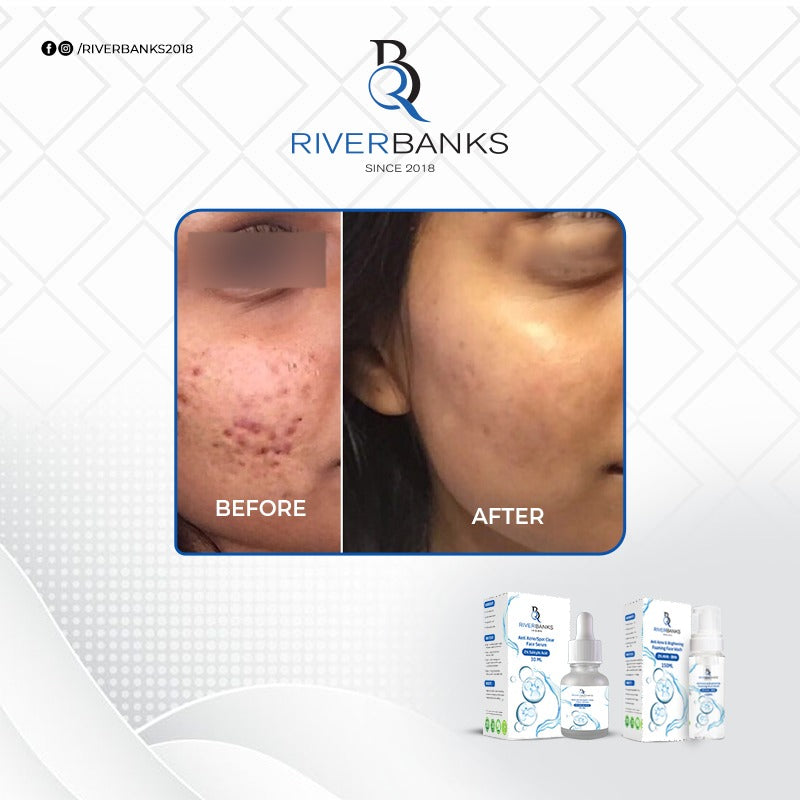 ఉత్తమ ఫలితాల కోసం ANTI ACNE COMBO